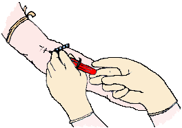 illustration of blood being drawn from an arm with a hypodermic needle for an AFP test sample
