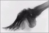 x-ray picture of a severly deformed and stunted foot