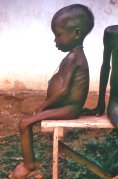photo of a young Nigerian girl with advanced kwashiorkor symptoms
