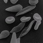 microscopic photo of deflated red cells from a human with sickle-cell anemia